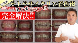 40代50代｜歯が黒い、歯が茶色いことで悩んでいる方必見！【テトラサイクリン着色歯特集】