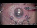 Macular hole surgery, 