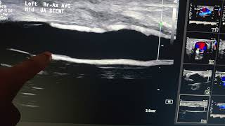 Pseudoaneurysm of left brachioaxillary graft with moderate stenosis at arterial and venous side.