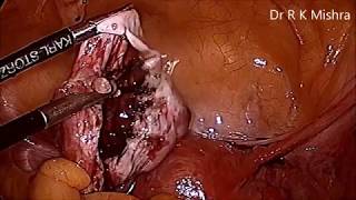 Laparoscopic Bilateral Ovarian Cystectomy