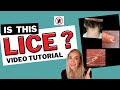 What Lice Look Like Video Tutorial