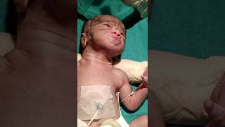 Bad condition Newborn baby after birth#shortsfeed#viral