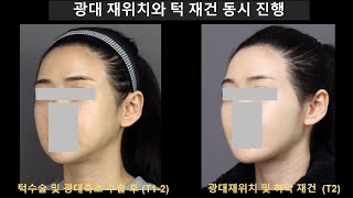 광대 재위치와 턱 재건 동시 진행(뒷광대 제거된 례)   Simultaneous Zygomatic Repositioning and Jaw Reconstruction