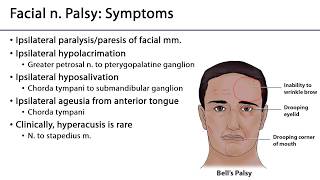 Face LO - Facial n. palsy