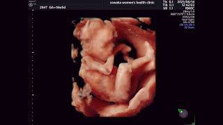 16 week 3D 4D Ultrasound - My baby! ❤️