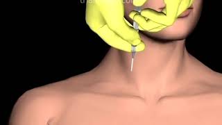 Internal Jugular Vein (IJV) Access in Hypovolemic Patient Animation by Cal Shipley, M.D.