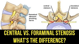 Central vs. Foraminal Cervical Stenosis: Key Differences Explained