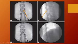 Intro to Neuromodulation, Pain Management and Interventional Spine Fellowships - Dr. David Lee