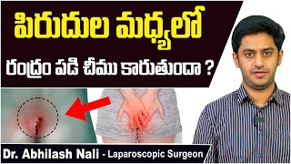 పిరుదుల మధ్యలో రంధ్రం పడి చీము కారుతుందా? || Pilonidal Sinus Causes and Symptoms || Dr Abhilash Nali