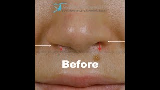 Revision Rhinoplasty Before and After Video