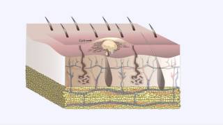 Common Skin Disorders- Cysts