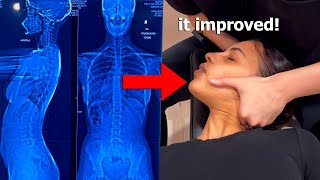 ASMR: Chiropractor Adjusts my Scoliosis with Neck and Back Cracks!