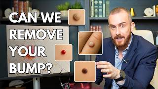 Skin Tags, Warts, Moles: Here’s What You Can Remove (And How)