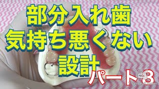 部分入れ歯その8　埼玉県さいたま市大宮鈴木歯科医院歯医者デンタル歯科クリニック　駅西口近く　歯周病　奥歯ない　良心的　優しい　骨がない　インプラント　スマイルデンチャー