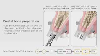 DS OmniTaper Guided Surgery - Surgical Animation