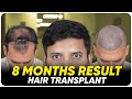 Hair Transplant in Turkey | Best Results & Cost of Hair Transplant in Turkey