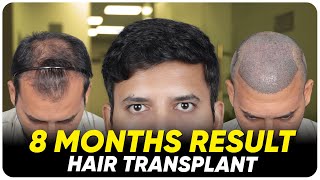 Hair Transplant in Turkey | Best Results & Cost of Hair Transplant in Turkey