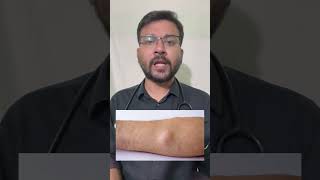 Can Lipoma be treated without surgery? Medicine for lipoma? Lipoma treatment by Dr Animesh #shorts