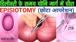 छोटे ऑपरेशन से बच्चे की डिलीवरी कैसे होती है | Episiotomy | Chhote operation se delivery