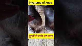 Hygroma of knee l Dr Umar Khan