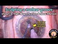 how to sculpt a nuclear groove in phaco / cataract surgery