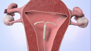 Patient Education Video: Intrauterine Device (IUD)