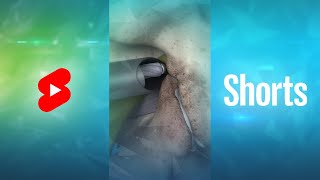 What is Endoscopic Lumbar Foraminotomy? #Shorts