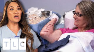 Dr. Lee Sets A New Record By Removing 68 Lipomas From This Woman's Arms! | Dr. Pimple Popper Pop Ups