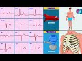 electrocardiograma interpretación