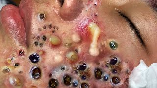 Blackheads Removal | Acne Treatment and Very Satisfying Satisfying Pimple pop #blackheads