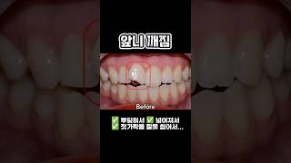 #앞니깨짐 #레진치료 사례와 주의사항  #의정부치과 #dentist #앞니부러짐 #치아깨짐