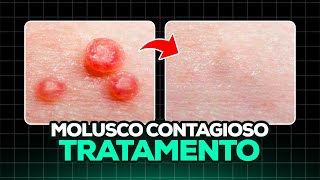 Molusco Contagioso - Como Eliminar Molusco Contagioso