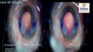 Live 3D surgery from Nandadeep Eye Hospital Dr Sourabh Patwardhan