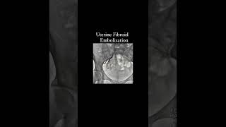 Uterine Fibroid Embolization #angioplasty #knowledge #cardiology