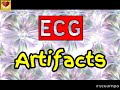 ecg artifacts