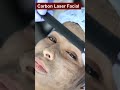 Here's what people are saying about carbon laser facial. #carbon_laser_facial #carbonlaser #shorts