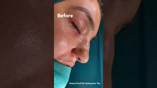 Closed Rhinoplasty | Another Dream Became Real