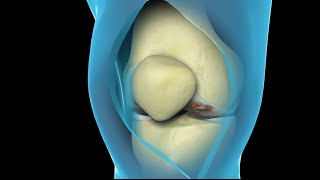 Total Knee Replacement Surgery | Nucleus Health
