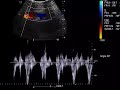 case 409 pulsating femoral vein in tricuspid regurgitation congestive heart failuretr chf