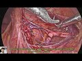 Laparoscopic pyeloplasty Dr Mukesh Ahir Urologist