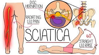 Sciatica Explained (Including Red Flag Symptoms)