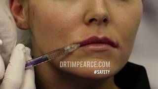 Does Aspiration before Injection of Dermal Fillers Work?  Proof caught on camera.