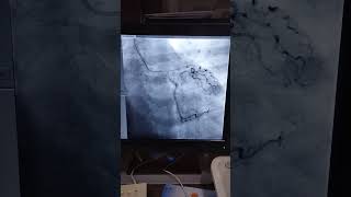 Inside the Heart: A Deep Dive into Cardiac Angiography#HeartCare