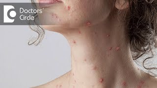 Which medicine can I use to remove chickenpox spots? - Dr. Vijaya Raghava Reddy