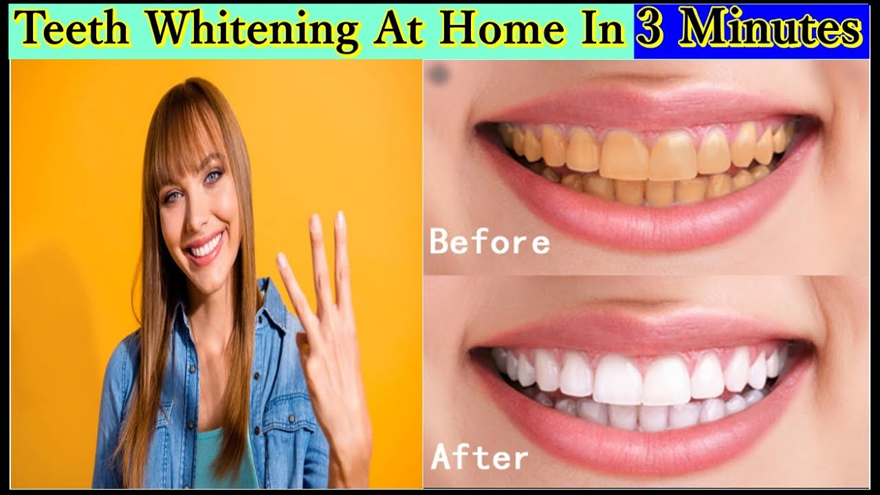 Teeth Whitening At Home In 3 Minutes || How To Whiten Your Yellow Teeth ...