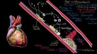 Khan Academy - Atherosclerosis in Heart Disease