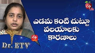 ఎడమ కంటి చుట్టూ వలయాలకు కారణాలు| డాక్టర్ ఈటీవీ | 9th ఆగస్టు 2022| ఈటీవీ  లైఫ్