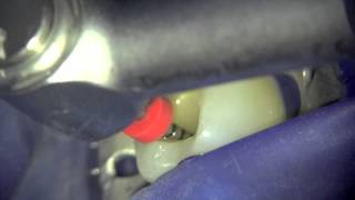 ProGlider and ProTaper Next (Dentsply/Maillefer) Case Report 1