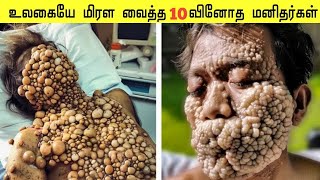 மிரள வைக்கும் வினோத மனிதர்கள் | The MOST Unusual People With Rare Condition | Galatta Info Tamil