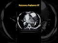 Pulmonary Angiogram CT Scan #pulmonaryangiogram #pulmonary #pulmonaryhypertension